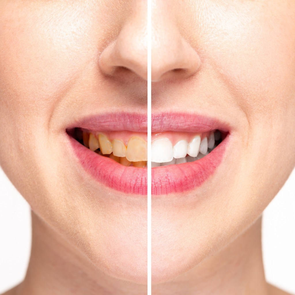 Teeth Whitening