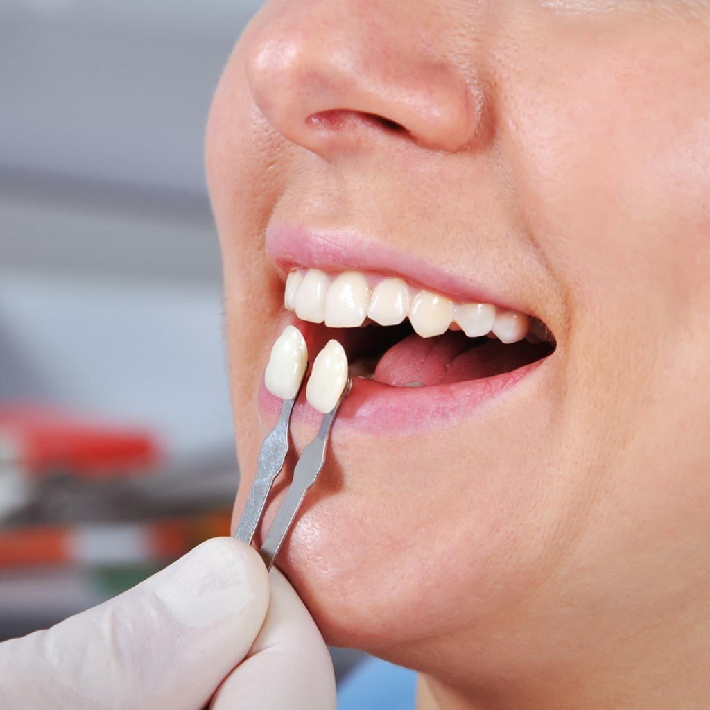 Veneers
