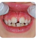 Frenectomy