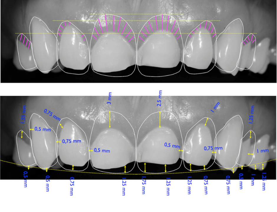 Digital smile designing treatment plan with measurements
